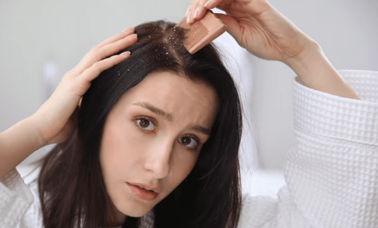 Dandruff Removal Tips: सर्दी खत्म होने के बाद भी नहीं जा रही सिर पर जमा रूसी तो ये नुस्खे आजमाकर देख लें