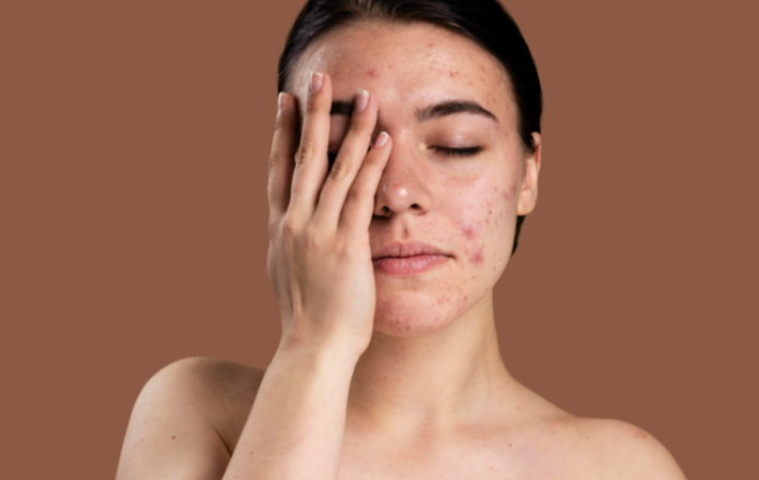 Acne Causes In Women: चेहरे पर बार-बार आते रहते हैं Pimple; तो एक नहीं, 6 कारण हो सकते हैं जिम्मेदार